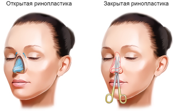 Az orr orrplasztikája: zárt, nyitott, rekonstruktív, injekciós, lézeres. Ár és vélemények