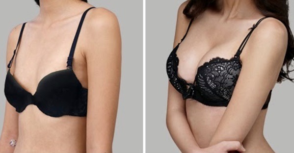 Cirurgia d’augment de mama. Fotos de noies amb pits grans, resultats, possibles complicacions