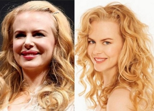 Nicole Kidman. Hình ảnh trước và sau khi phẫu thuật thẩm mỹ, thời trẻ, bây giờ, hình