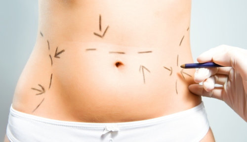 Liposucció làser de l’abdomen. Foto, rehabilitació, conseqüències, preu, ressenyes