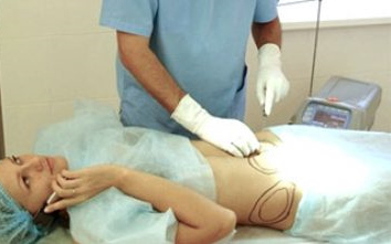 Laser liposuction ng tiyan. Larawan, rehabilitasyon, kahihinatnan, presyo, pagsusuri