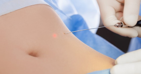 Laser-Fettabsaugung des Abdomens. Foto, Rehabilitation, Folgen, Preis, Bewertungen
