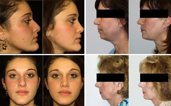 Contorn facial des de la doble barbeta. Fotos abans i després de la cirurgia, preu, ressenyes