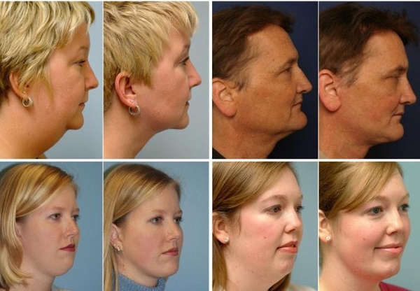 Konturowanie twarzy od podwójnego podbródka. Zdjęcia przed i po zabiegu, cena, recenzje