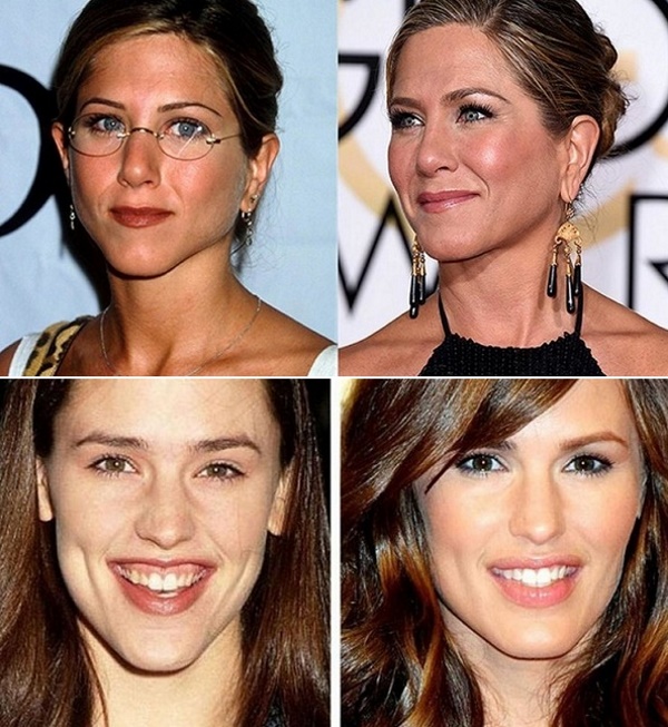 Contorn facial des de la doble barbeta. Fotos abans i després de la cirurgia, preu, ressenyes