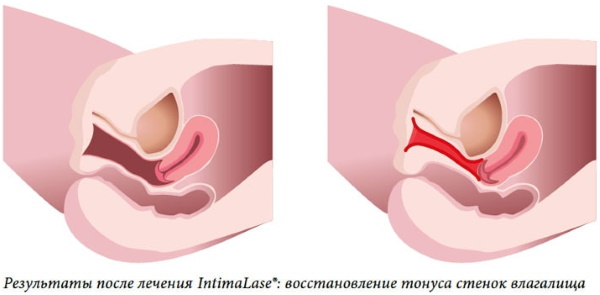 Rejoveniment làser de la vagina (vaginoplàstia després del part). Opinions, preu