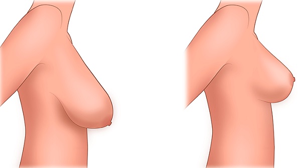 Dónde hacerse la cirugía plástica de mama. Precios, reseñas, fotos antes y después