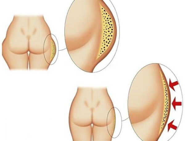 Liposukcja ud, grube nogi u kobiet. Zdjęcia przed i po, cena, recenzje