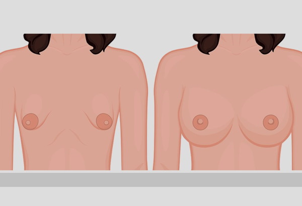 Forma tubular de les glàndules mamàries, els pits. Foto, correcció sense cirurgia per a dones, homes