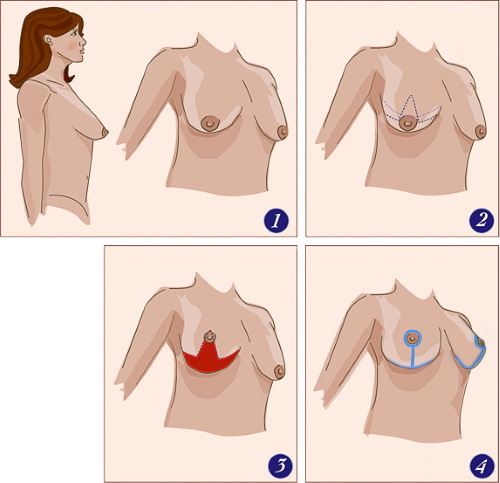 Forma tubular de glándulas mamarias, mamas. Foto, corrección sin cirugía para mujeres, hombres.
