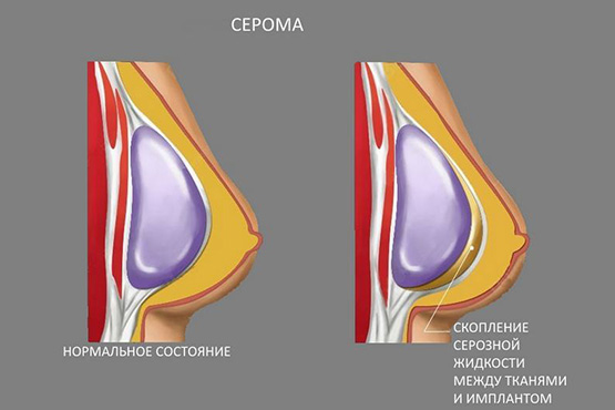 Forma tubular de glándulas mamarias, mamas. Foto, corrección sin cirugía para mujeres, hombres.