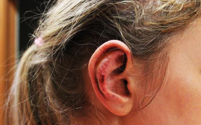 Cirurgia de l’oïda per l’orella. Quin és el preu