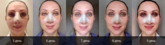 La niña tiene una nariz larga. Fotos antes y después de la rinoplastia