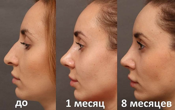 La fille a un long nez. Photos avant et après la rhinoplastie
