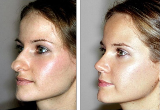Dziewczyna ma długi nos. Zdjęcia przed i po korekcji nosa