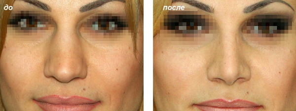 Dziewczyna ma długi nos. Zdjęcia przed i po korekcji nosa