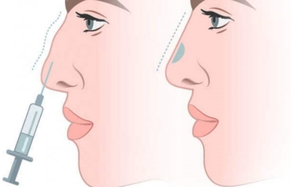 Dziewczyna ma długi nos.Zdjęcia przed i po korekcji nosa