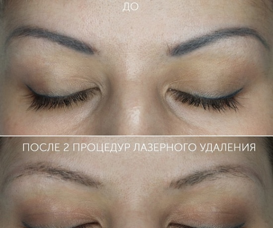 Élimination au laser du maquillage permanent (tatouage) des sourcils, des lèvres, des paupières