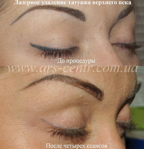 Laserowe usuwanie makijażu permanentnego (tatuażu) brwi, ust, powiek
