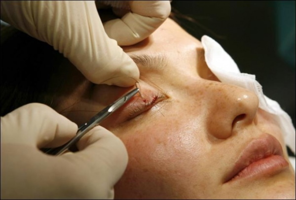 Plastische Chirurgie an den Augenlidern. Vorher und nachher Fotos, Preis, Bewertungen