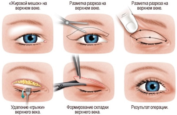Phẫu thuật tạo hình mí mắt. Ảnh trước và sau, giá cả, đánh giá