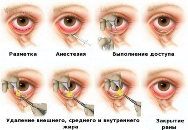 Phẫu thuật tạo hình mí mắt. Ảnh trước và sau, giá cả, đánh giá