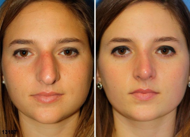 La noia té un nas gran. Fotos abans i després de la rinoplàstia