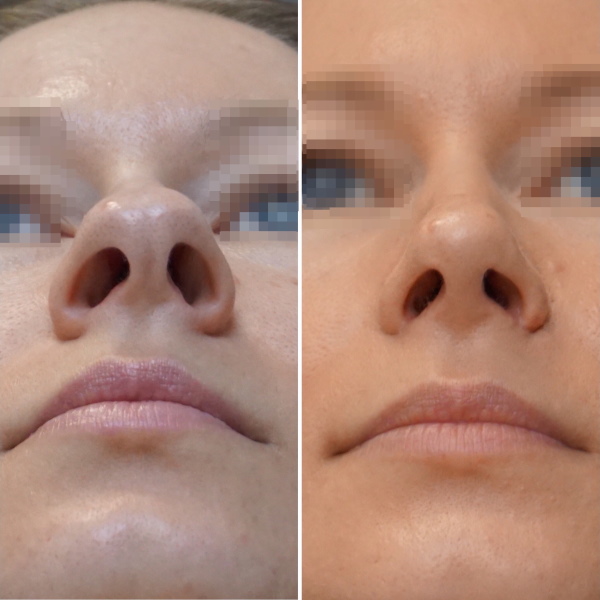 Dziewczyna ma duży nos. Zdjęcia przed i po korekcji nosa