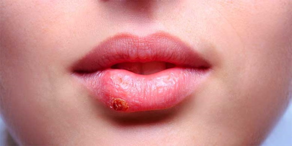 สาว ๆ มีริมฝีปากบาง วิธีเพิ่มไฮยาลูโรนิกฟิลเลอร์โบทอกซ์